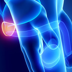 Overview on Prostate Cancer Types show